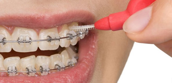 ortodonti-tedavi-nedir-005.jpg
