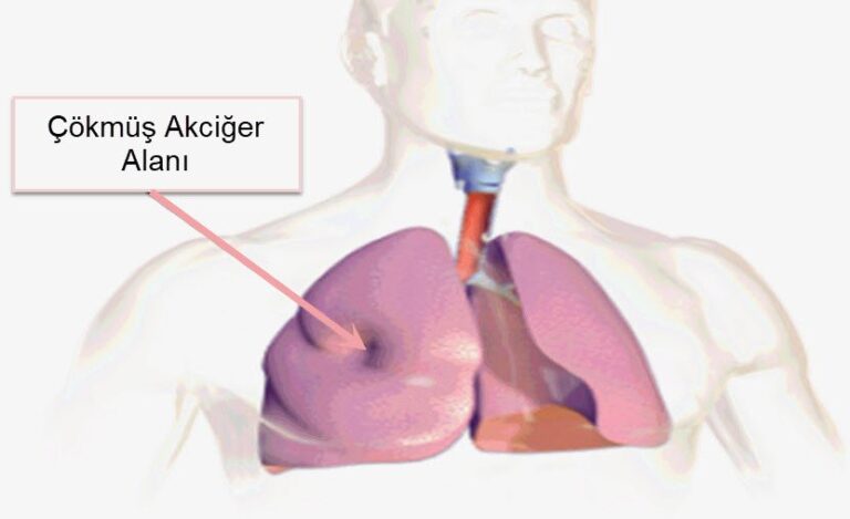 atelektazi nedir.jpg(Ã)