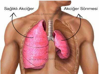 akciğer sönmesi pnömotoraks